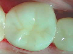 Fogfehérítés, fogkezelés